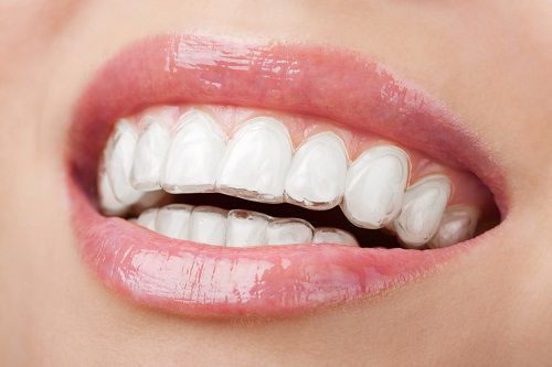 Niềng răng Invisalign